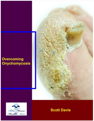 Overcoming Onychomycosis Overcoming Onychomycosis Reviews